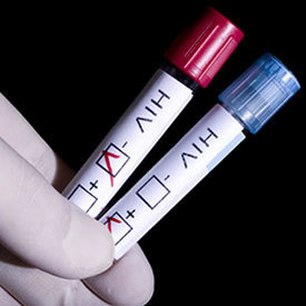 Hiv 20infection
